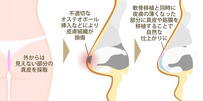 軟骨移植と同時に臀部真皮を移植するイメージ