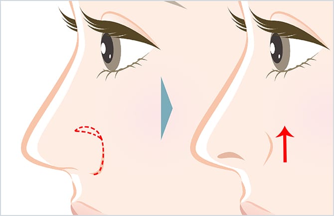 小鼻挙上術のイメージ