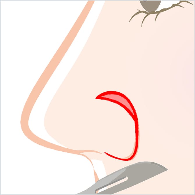 鼻の切開イメージ