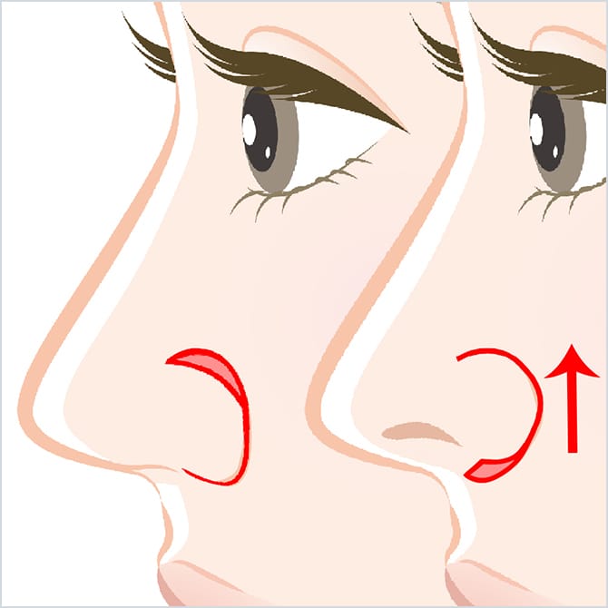 小鼻を持ち上げるイメージ