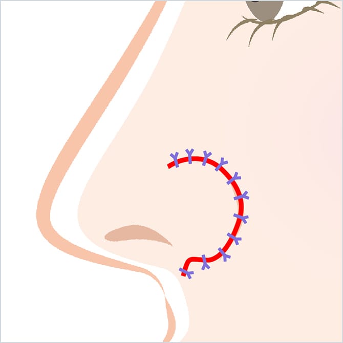 鼻の縫合イメージ