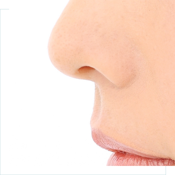 鼻唇角形成術（猫手術）