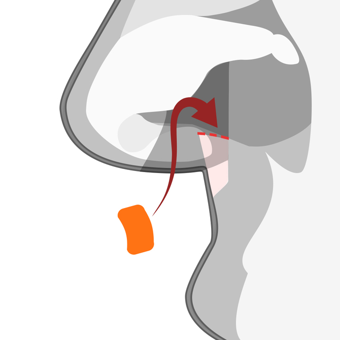 鼻柱基部の剥離と自家組織の挿入の図