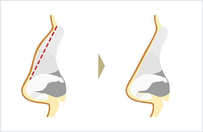 鼻 の 骨 削る 手術