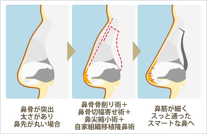 鼻の形に合わせて複数の施術を組み合わせるイメージ