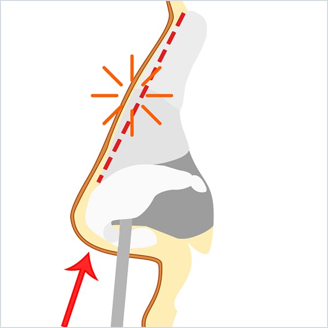 鼻の中から骨切り用のノミを使用し、骨を削る図