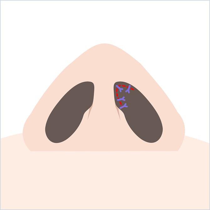 切開部分を縫合する図