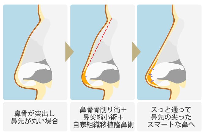 鼻尖縮小術+自家組織移植術