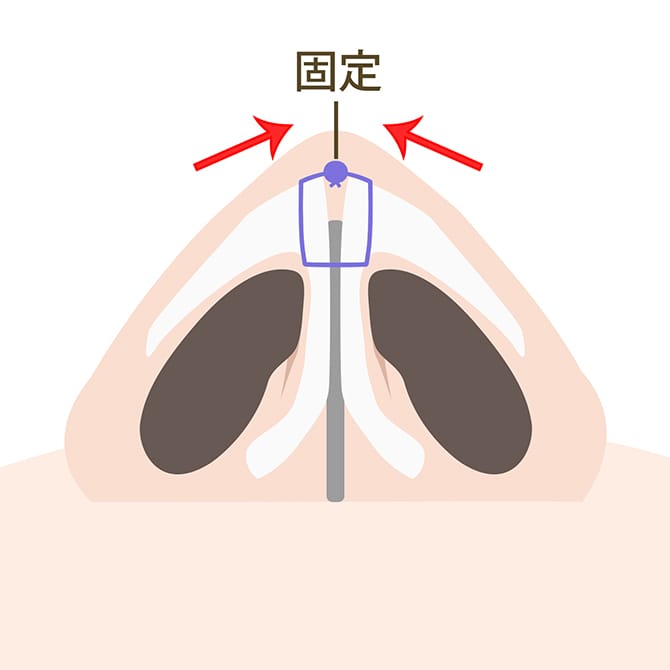 鼻孔の切開部分を縫合するイメージ