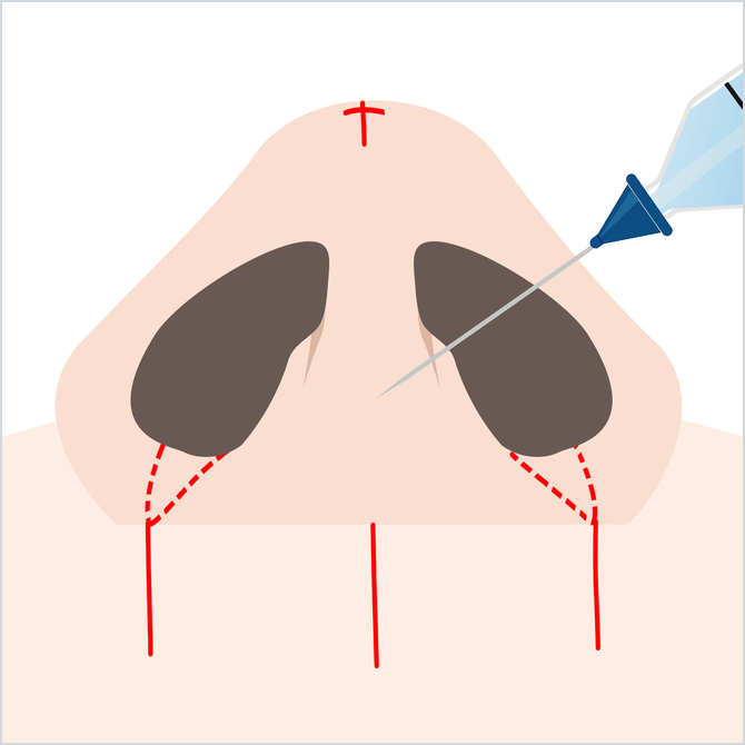 鼻にマーキングする図