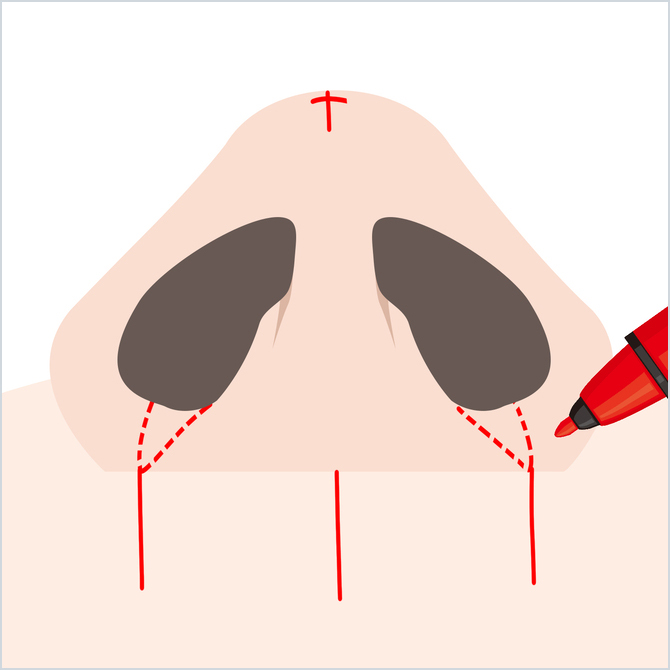 鼻に麻酔する図