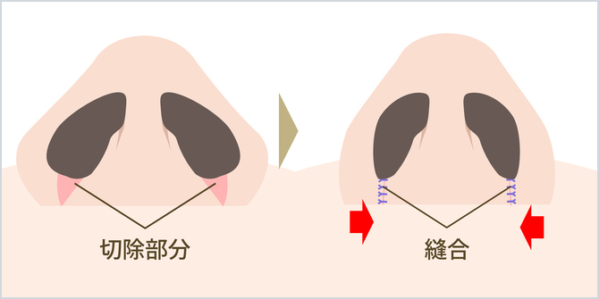 内側法のイメージ