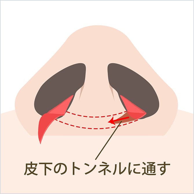 皮下のトンネルに通す図