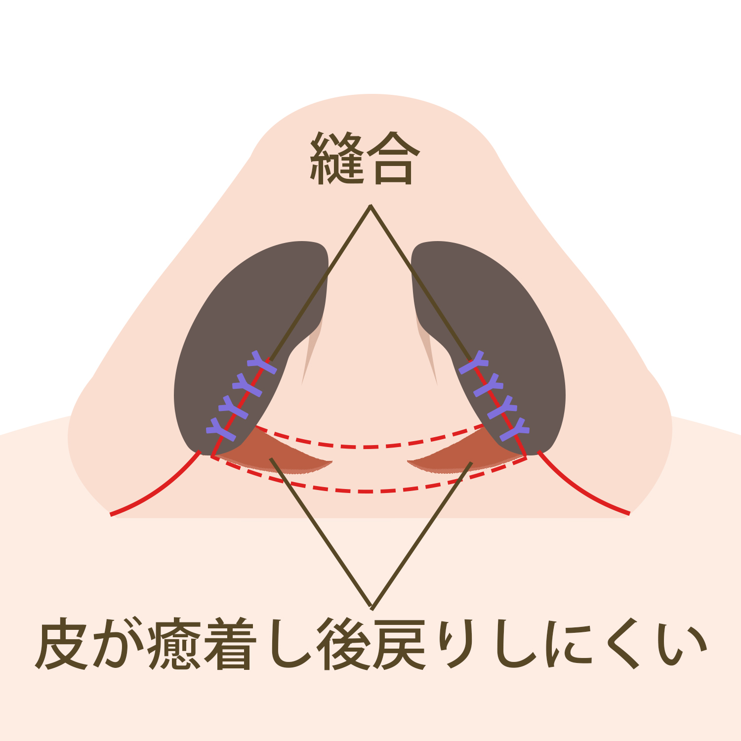 皮弁法のイメージ