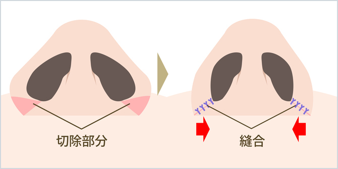 外側法のイメージ