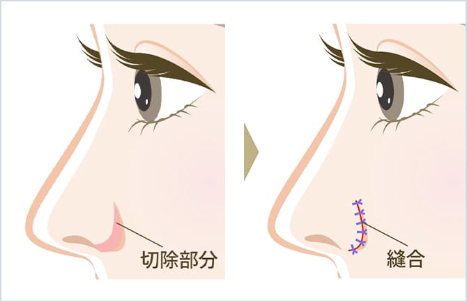 外側法のイメージ