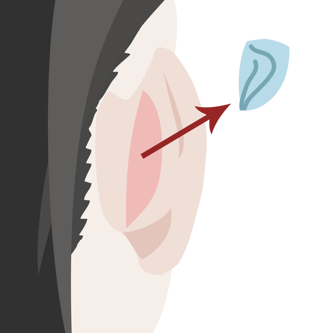 耳介軟骨採取イメージ