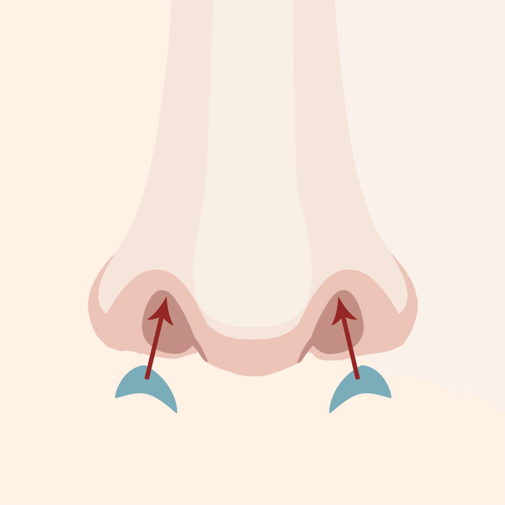 鼻孔縁部分を剥離し自己組織を挿入するイメージ