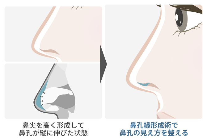 他の鼻整形との組み合わせで完成度をアップ