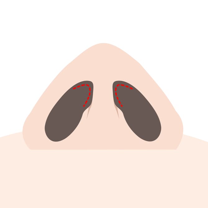 軟骨部分に切り込みを入れる図