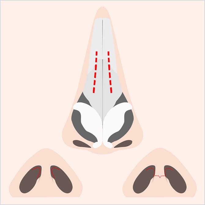 軟骨部分に切り込みを入れる図