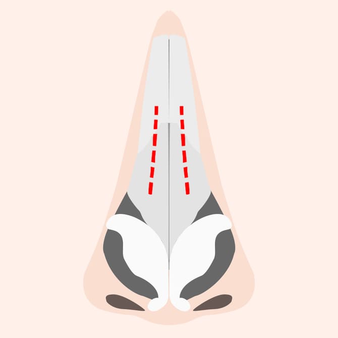 鼻の横の皮膚を切開する図