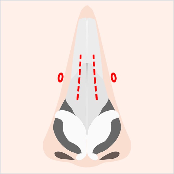 鼻の横の皮膚を切開する図