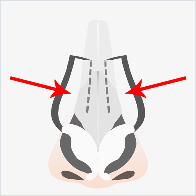 骨を真ん中に向けてずらす図
