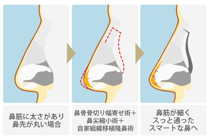 鼻尖縮小術+自家組織移植術