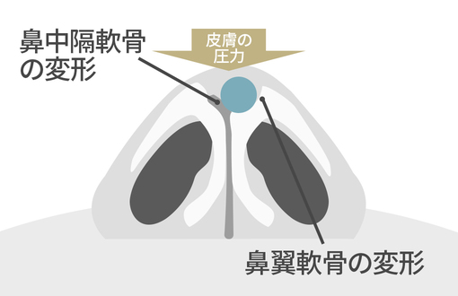 鼻中隔軟骨・鼻翼軟骨の変形