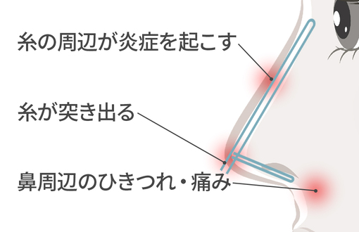 スレッドノーズ・フレックスノーズ・Gメッシュによる失敗