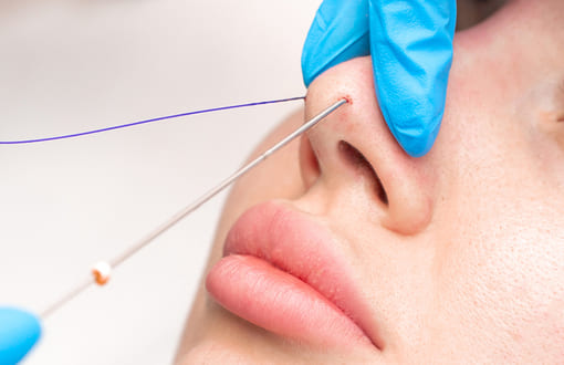 スレッドノーズ・フレックスノーズ・Gメッシュ施術イメージ