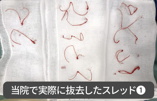 当院で実際に抜去したスレッド1