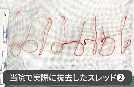 当院で実際に抜去したスレッド2