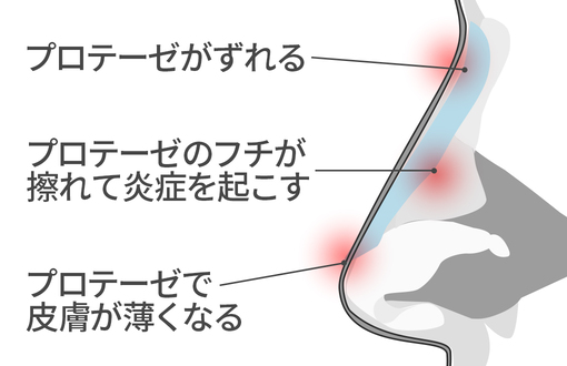 鼻プロテーゼによる失敗