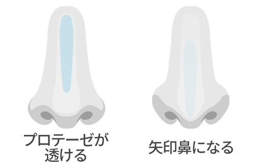 プロテーゼが透ける・矢印鼻になる
