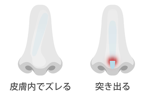 プロテーゼが皮膚内でズレる・突き出る