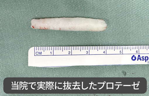 当院で実際に抜去したプロテーゼ