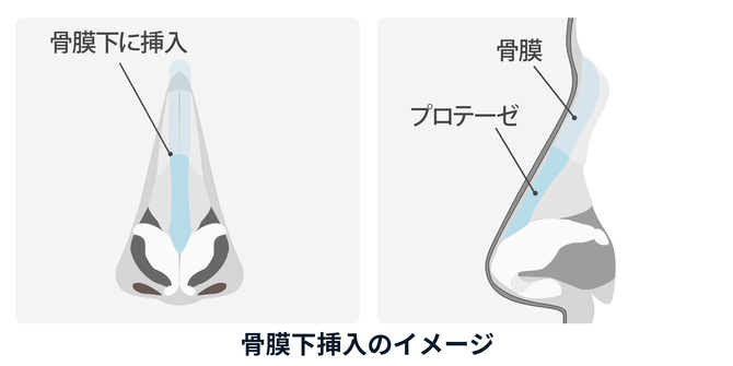 プロテーゼの入れ替え
