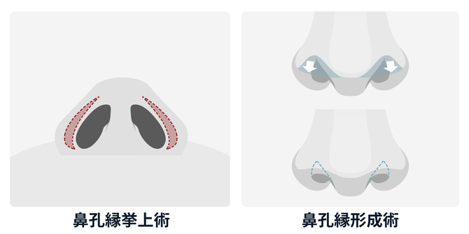 自家組織で再手術