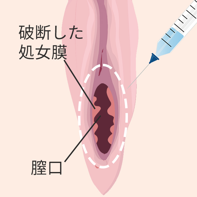 処女膜 処女膜再生 | 美容整形外科のジョウクリニック
