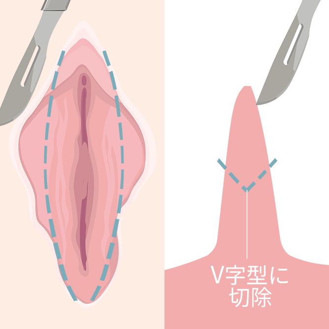小陰唇を切除