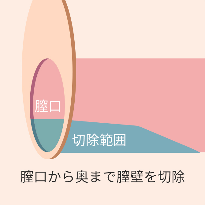 膣口から奥まで膣壁を切除