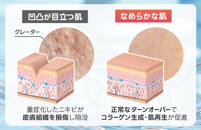 お肌の凹凸治療にも効果的