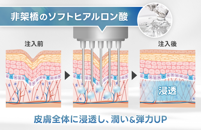 潤いを補給する水光注射の基本