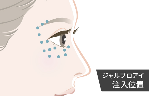 ジャルプロ アイの注入位置