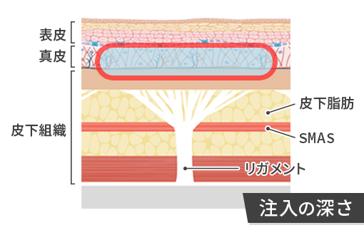 ジャルプロHMWの注入の深さ
