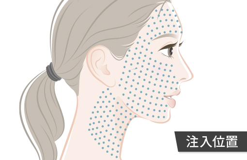 プルリアル デンシファイの注入位置