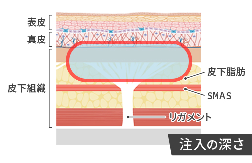 プルリアル デンシファイの注入の深さ
