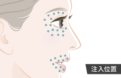 プルリアル シルクの注入位置